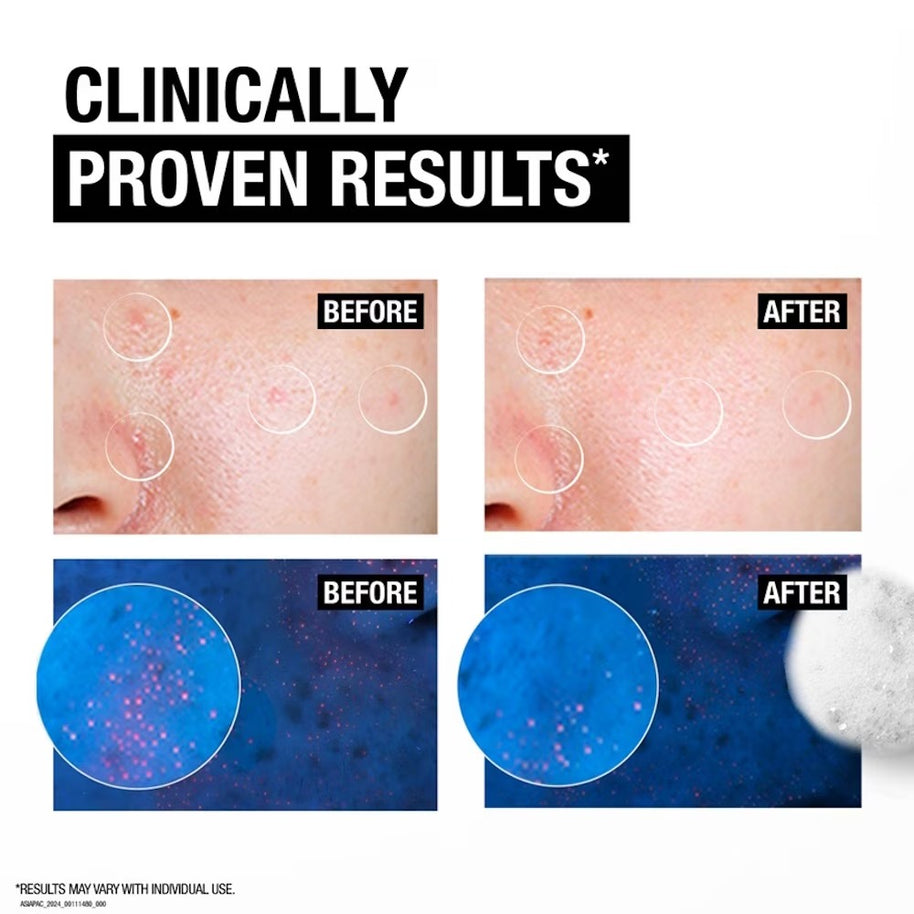 NEUTROGENA Deep Clean Acne Foaming Cleanser (For Acne Prone Skin)100g